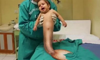 Insolite/Enfant né avec le syndrome de la sirène : Un drame familial