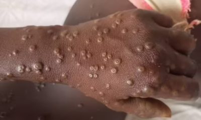 Santé - Cri d'Alerte : La Mpox, un virus plus viral que la COVID-19 fait déjà rage