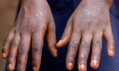 Alerte Mpox à Lomé : un cas confirmé, la vigilance s’impose