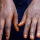 Alerte Mpox à Lomé : un cas confirmé, la vigilance s’impose