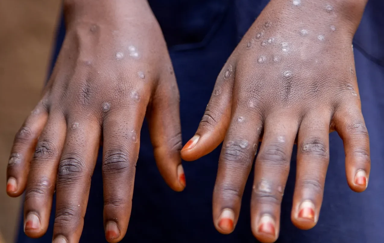 Alerte Mpox à Lomé : un cas confirmé, la vigilance s’impose