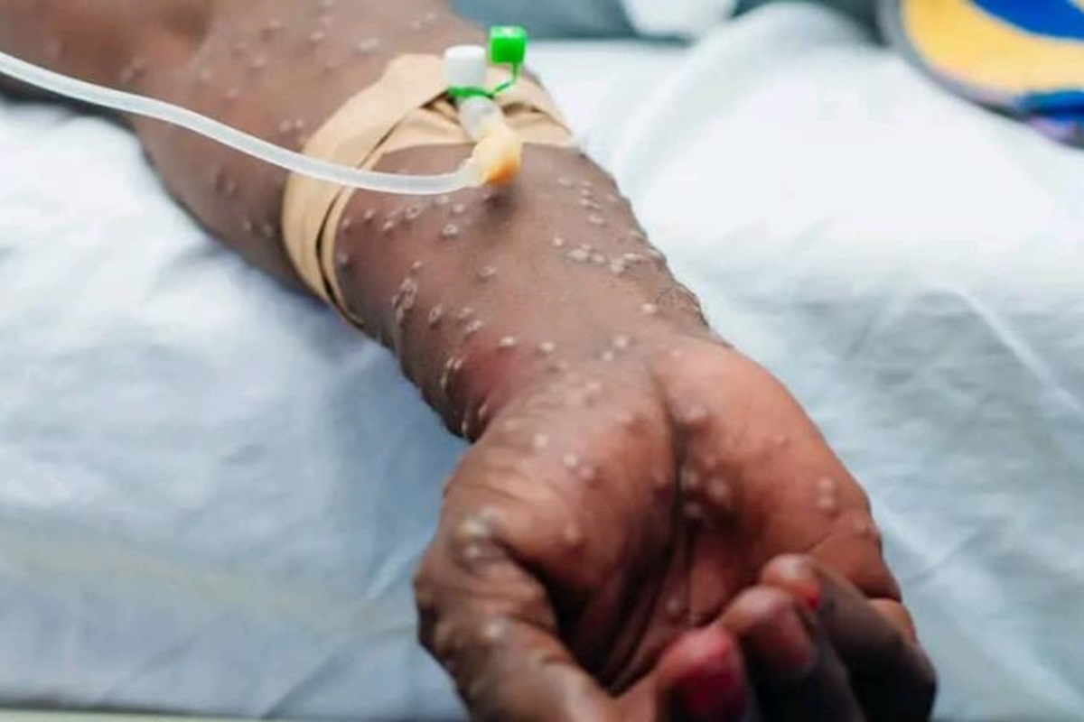 Togo : Un premier cas de variole simienne confirmé – le gouvernement appelle à la vigilance